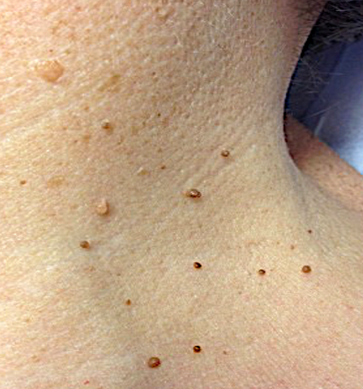 Wart removal serum